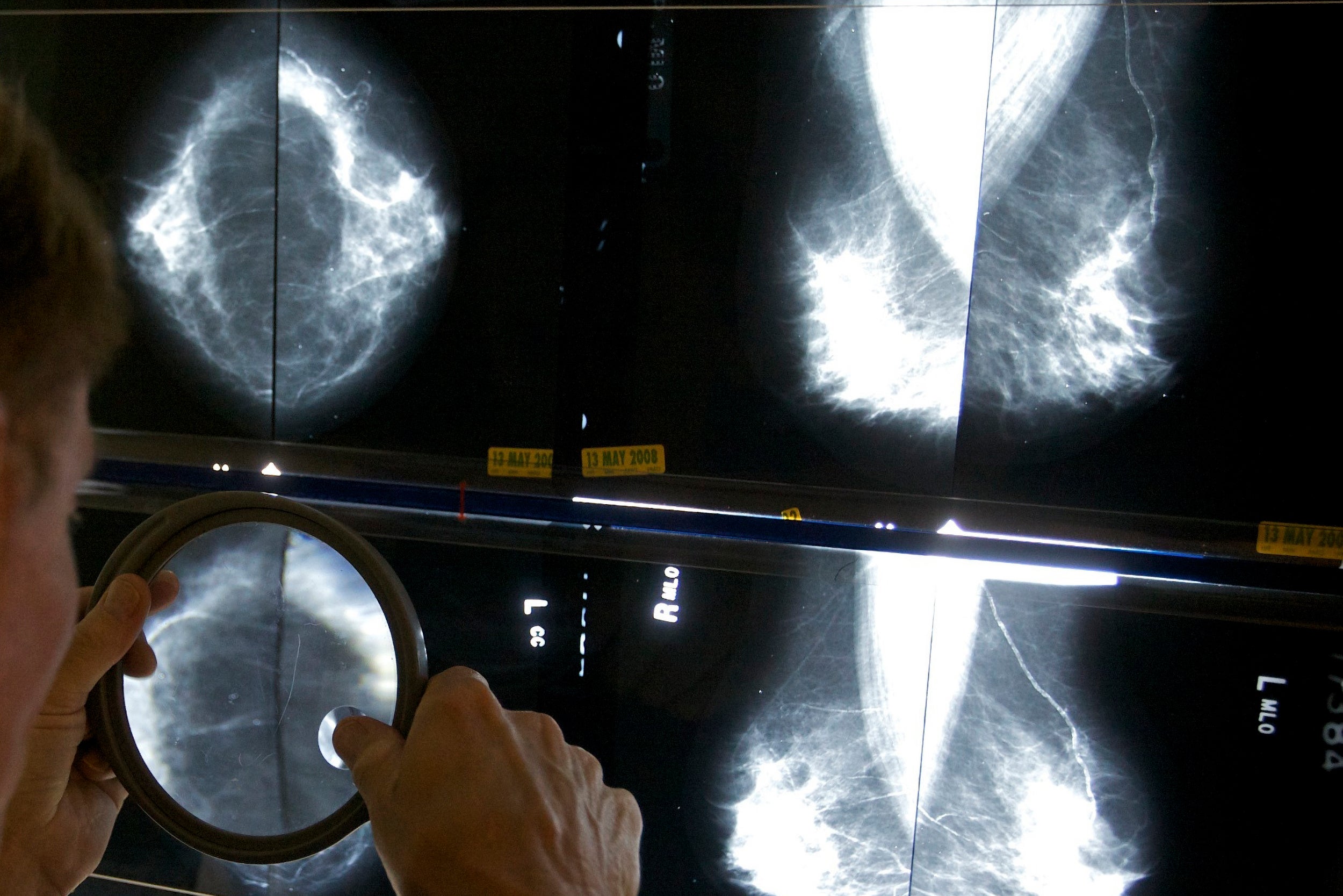 Radiologist examines mammograms with magnifying glass.