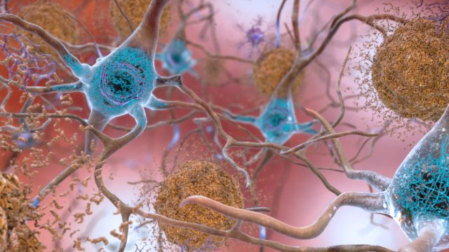 Newly identified genetic variant protects against Alzheimer’s