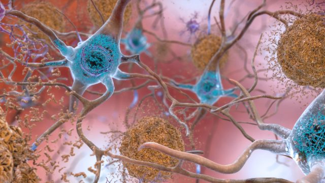 Hallmarks of Alzheimer’s found well before diagnosis