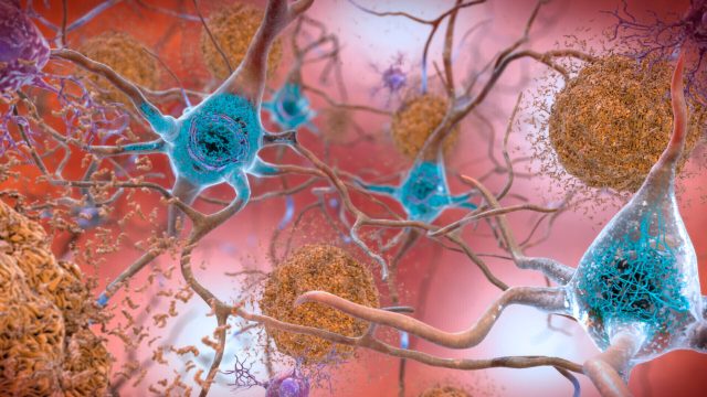 Start of new era for Alzheimer’s treatment