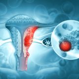 Model predicts risk of endometrial cancer