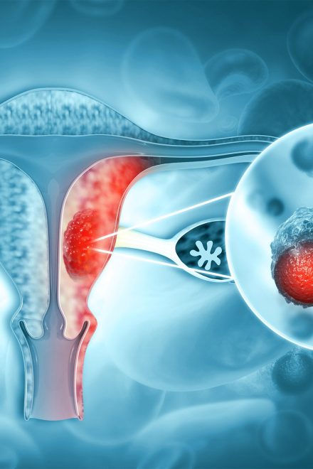 Model predicts risk of endometrial cancer