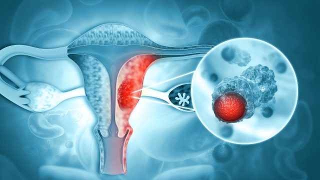 Model predicts risk of endometrial cancer